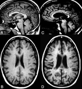 cerebrovascular system health - brain aging