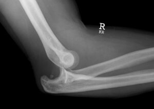 posterior elbow dislocation