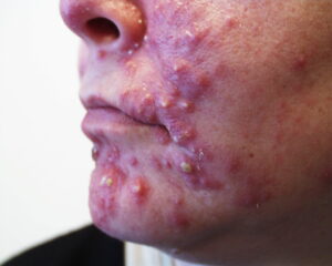 prevent acne