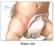 Common skin rashes - diaper rash