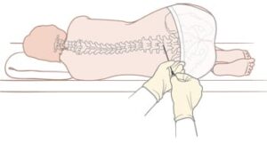 spinal tap lumbar puncture