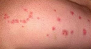 bed-bug-insect-bites-arm