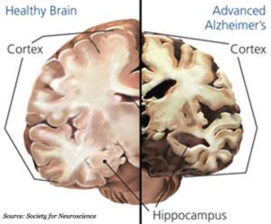 health vs unhealthy brain