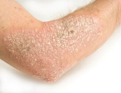 Common skin rashes - psoriasis
