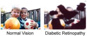 diabetic retinopathy and eye vision