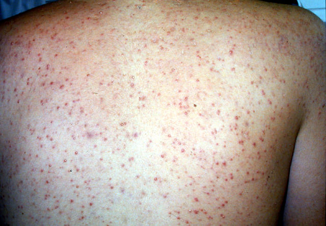 Common skin rashes - Drug eruptions