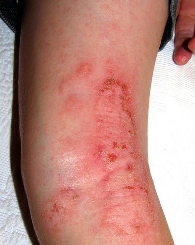 Common skin rashes - eczema