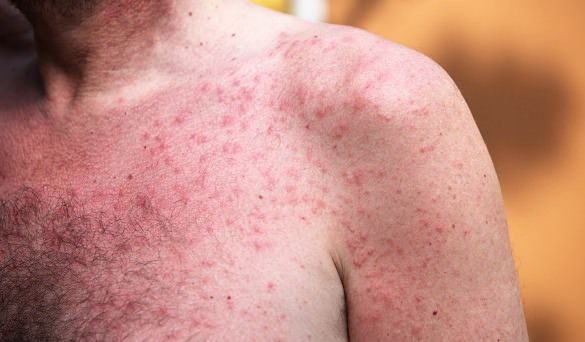 Common skin rashes - heat rash