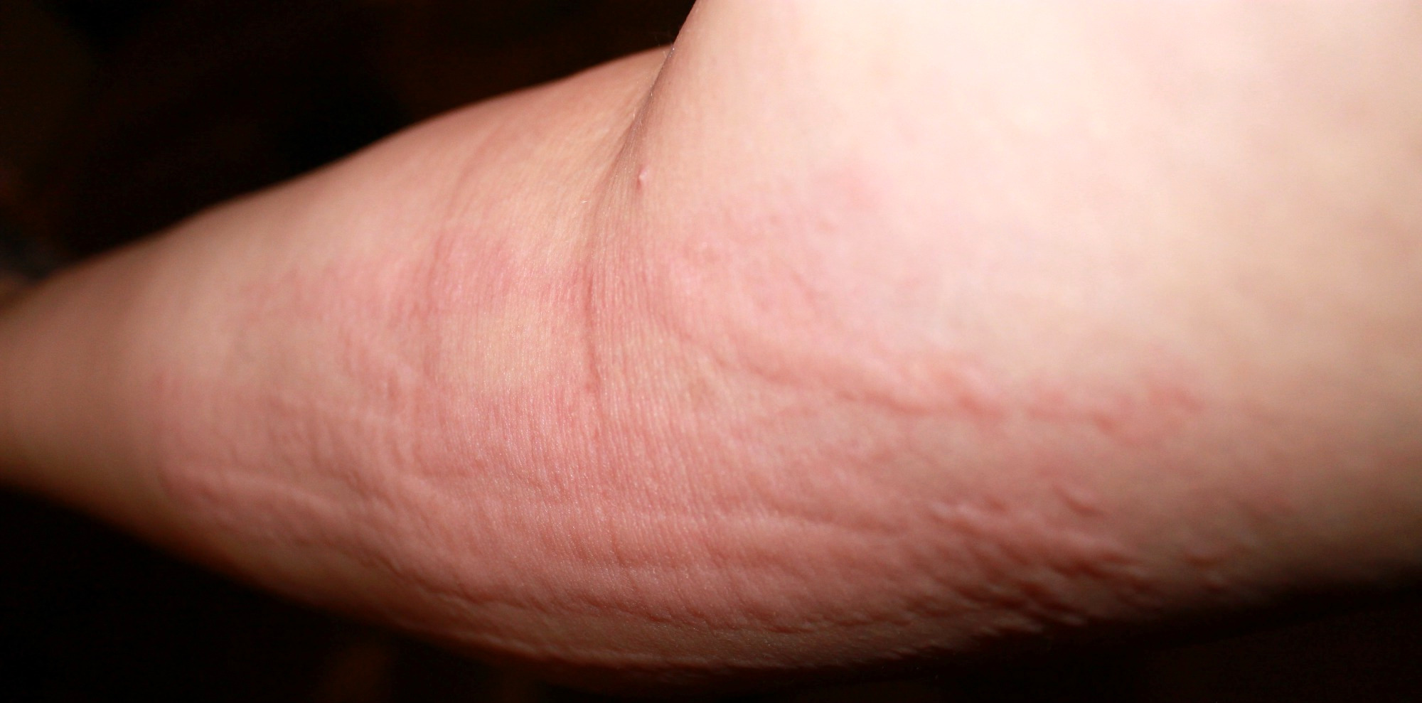 Common skin rashes - hives