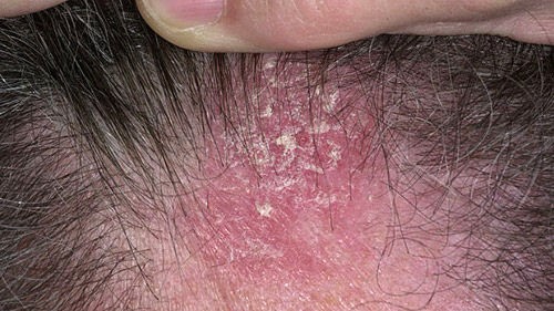 Common skin rashes - seborrheic dermatitis