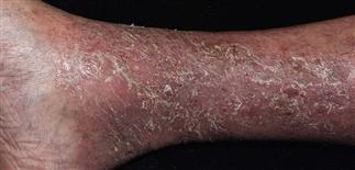 common skin rashes - stasis dermatitis